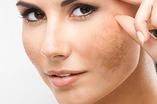 Nám da là vấn đề thường gặp ở phụ nữ tuổi trung niên