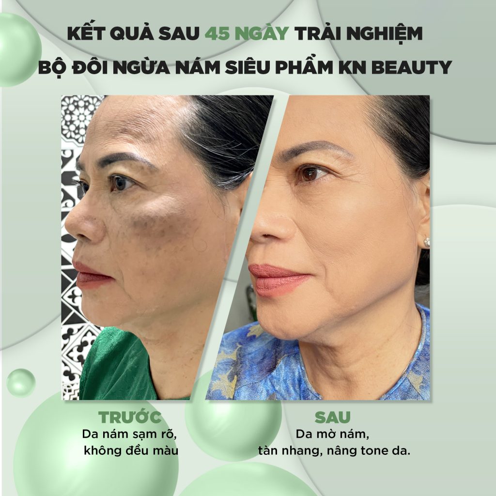chăm sóc da nám với kn beauty