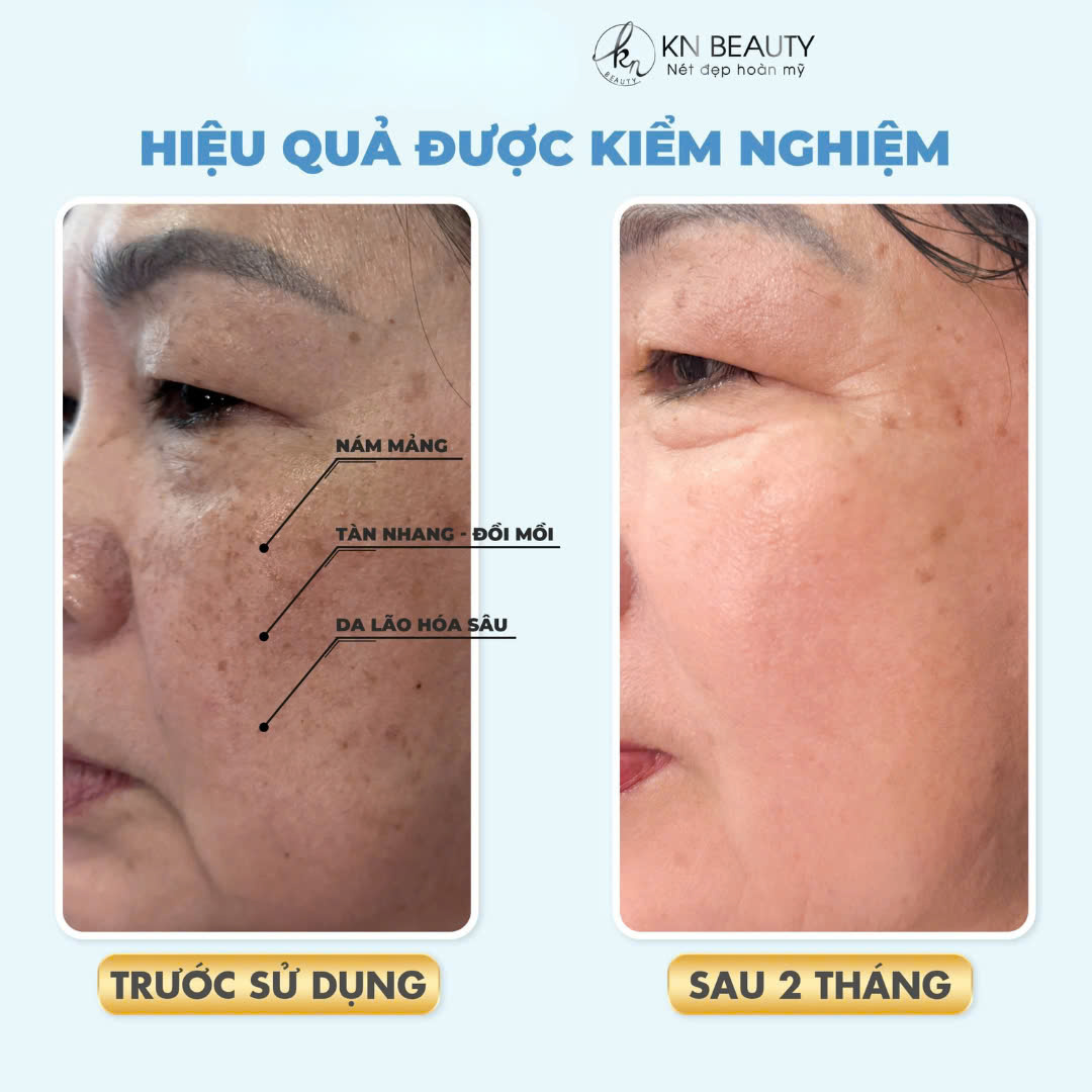 Trước và Sau khi Sử Dụng Sản Phẩm KN Beauty